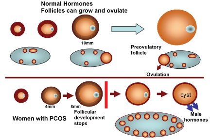 Ayurvedic PCOS/PCOD Clinic in Kopar khairane