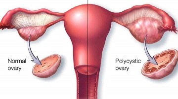 Ayurvedic PCOS/PCOD Clinic in Kopar khairane